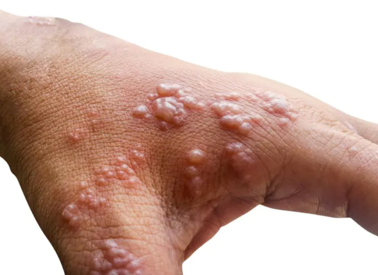 Monkeypox Cases Linked to Sexual Contact and LGBT Networks