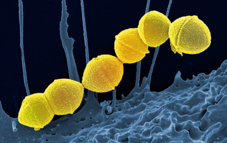 Strep A Kills More Children Than Covid Did in its First Year – as Deaths are Blamed on Lockdown Immunity Debt