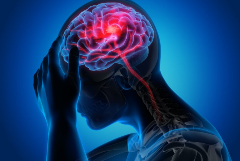 Risk of Stroke Skyrockets in Vaccinated on Covid Infection