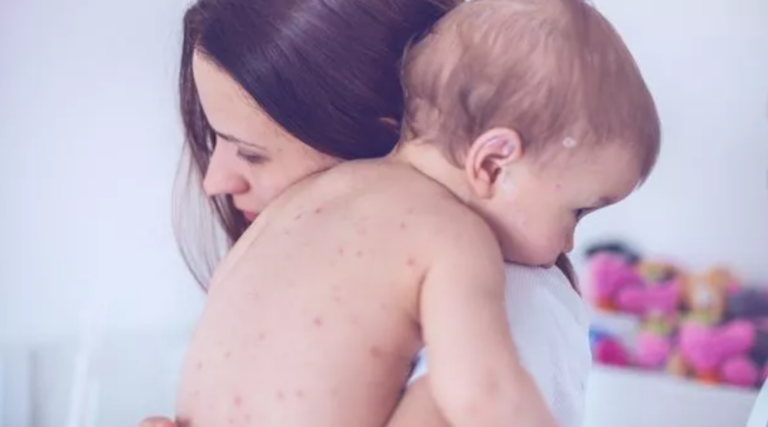 Vaccine ‘Misinformation’ Isn’t to Blame for Rising Measles Cases